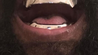 Kanye West Teeth