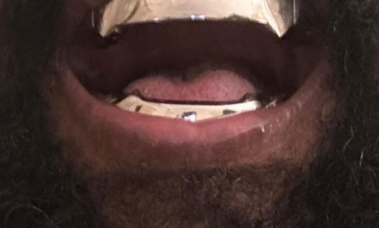 Kanye West Teeth