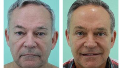 Face Lift Before and After