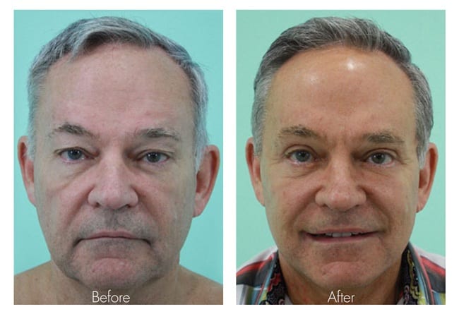 Face Lift Before and After